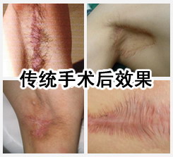 传统手术弊端 传统手术术后效果.JPG