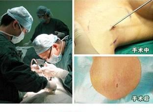 有狐臭会伴有油耳为什么 手术过程.jpg