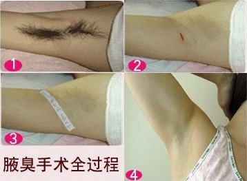 伤口追 伤口追踪